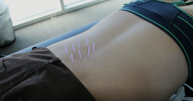Dry Needling